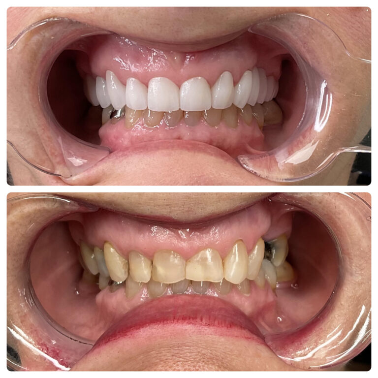 smile transformation teeth whitening at SP Smile 3