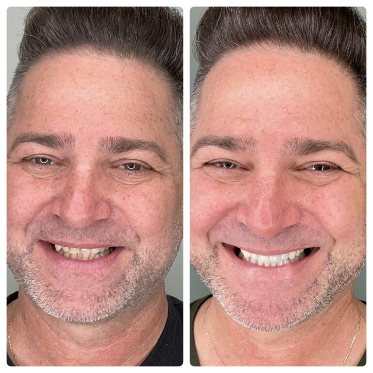 male smile transformation teeth whitening at SP Smile