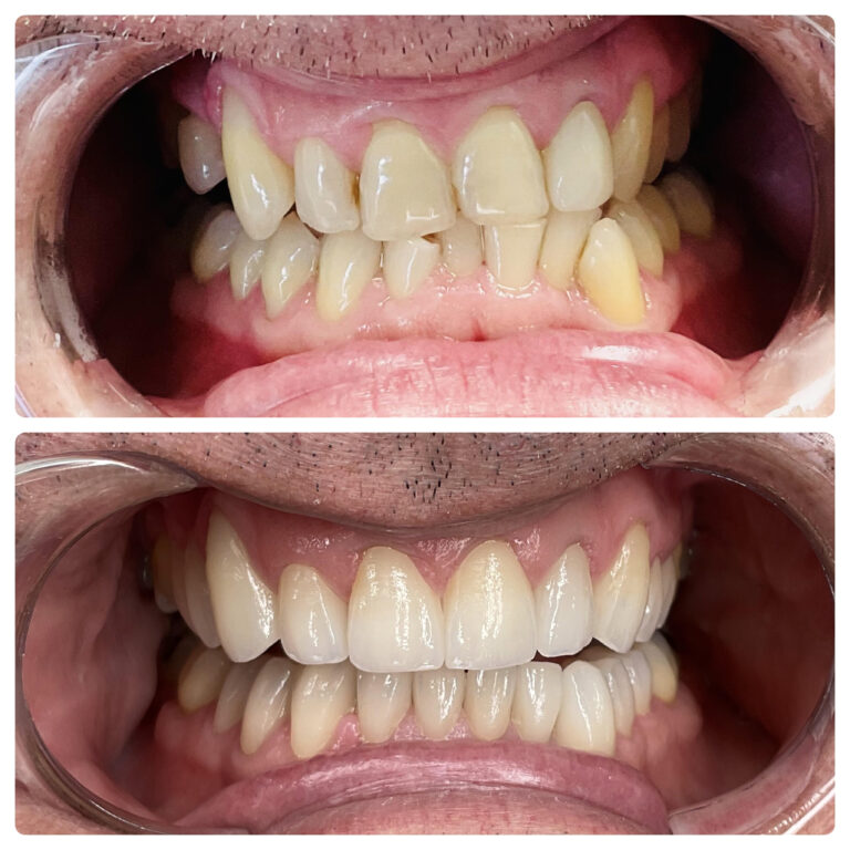 male 2 smile transformation teeth whitening at SP Smile