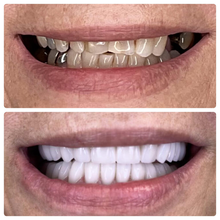 smile transformation teeth whitening at SP Smile